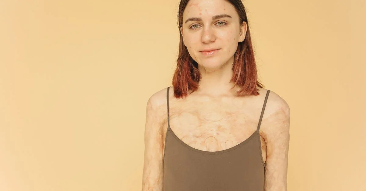 Une jeune femme avec des cicatrices de brûlures souriant avec confiance sur un fond beige.