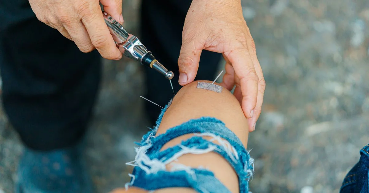 Gros plan sur un traitement d'acupuncture au genou d'une personne en extérieur, mettant l'accent sur la guérison naturelle.
