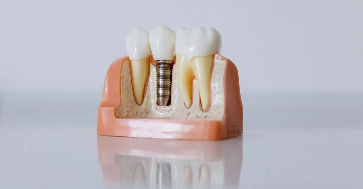 Modèle d'implant dentaire détaillé montrant la structure des dents à des fins éducatives.